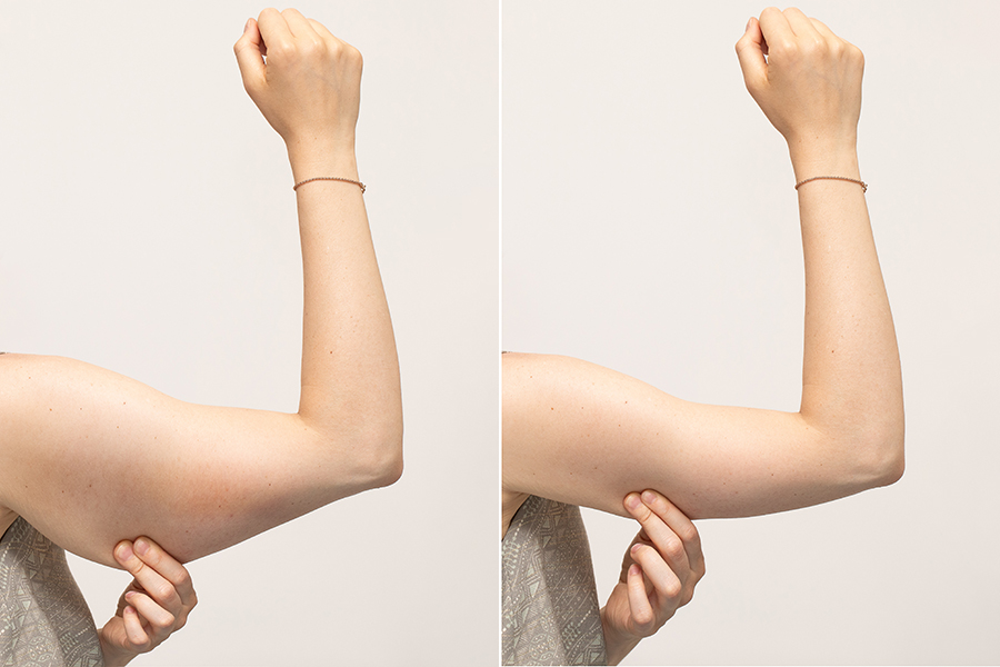 A split screen of a woman pinching the skin beneath her arm showing the before and after results of brachioplasty surgery, also called an arm lift