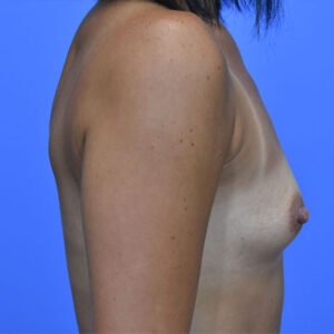 Breast Augmentation before and after photos