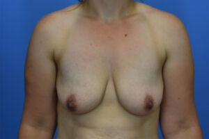 Breast Lift before and after photos