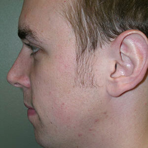 Chin Augmentation before and after photos