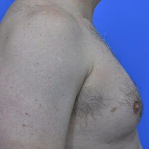 Male Breast Reduction before and after photos