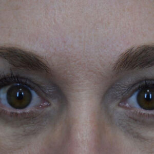 Eyelid Surgery before and after photos