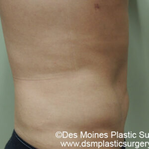 Liposuction before and after photos