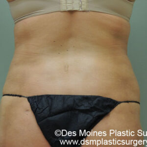 Liposuction before and after photos