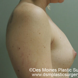 Breast Augmentation before and after photos