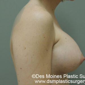 Breast Augmentation before and after photos