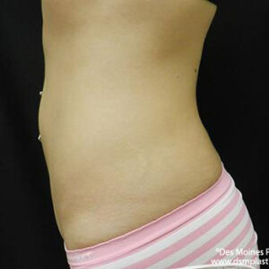 CoolSculpting before and after photos