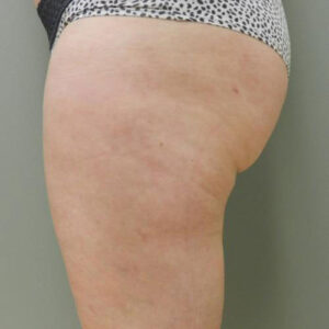 Liposuction before and after photos