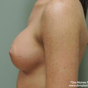 Breast Augmentation before and after photos