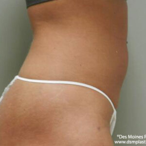 Liposuction before and after photos