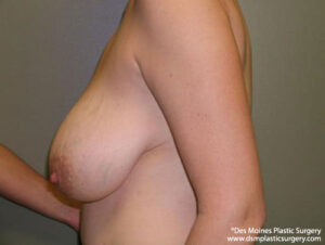 Breast Lift before and after photos