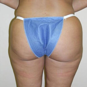 Liposuction before and after photos