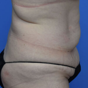 Tummy Tuck before and after photos