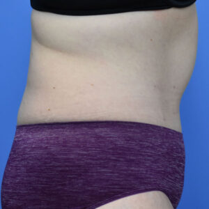 Tummy Tuck before and after photos