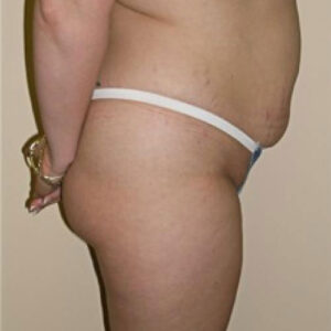 Liposuction before and after photos