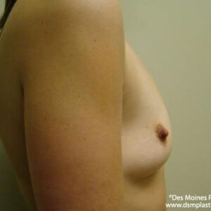 Breast Augmentation before and after photos