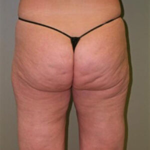 Liposuction before and after photos