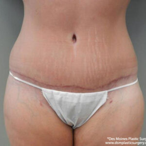 Tummy Tuck before and after photos