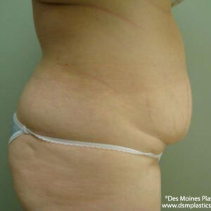 Tummy Tuck before and after photos