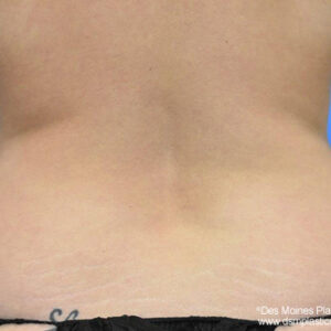 Liposuction before and after photos