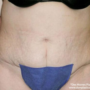 Tummy Tuck before and after photos