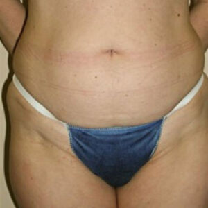 Liposuction before and after photos