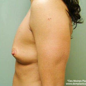 Breast Augmentation before and after photos