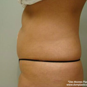 Liposuction before and after photos