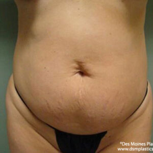 Tummy Tuck before and after photos