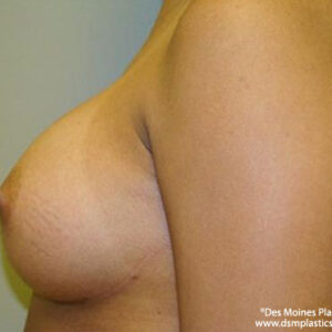 Breast Augmentation before and after photos