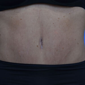 Tummy Tuck before and after photos