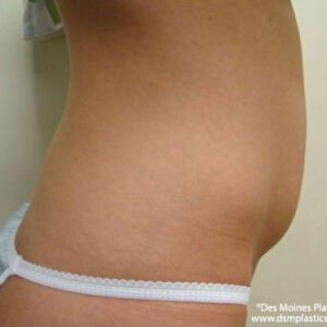 Liposuction before and after photos