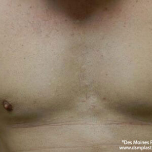 CoolSculpting before and after photos