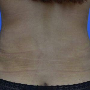 Liposuction before and after photos