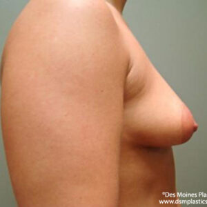 Breast Lift with Augmentation before and after photos