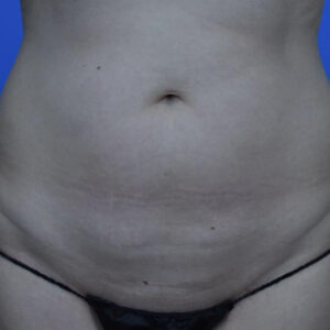 Liposuction before and after photos