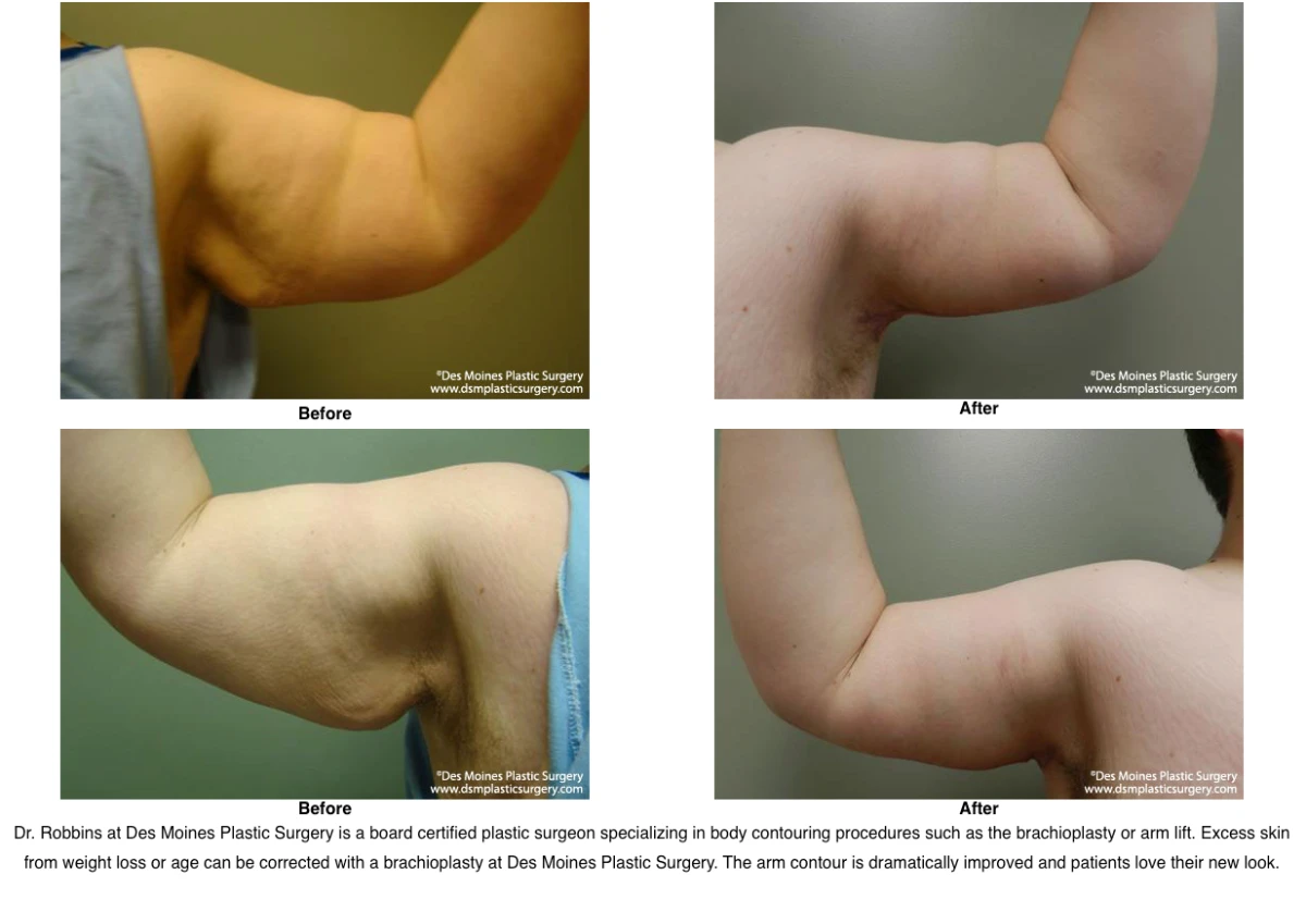 Arm Lift Before and After Performed by Dr David Robbins