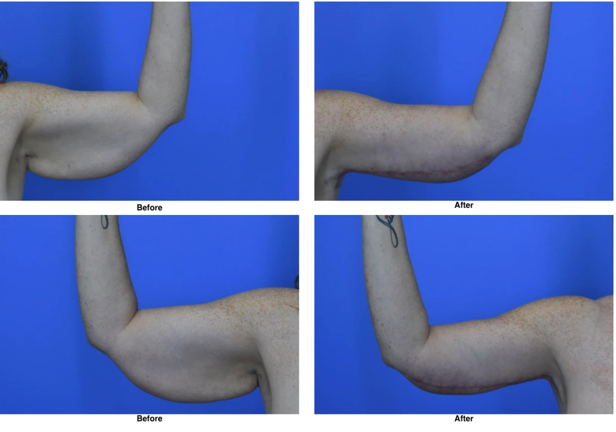 Arm Lift Before and After Performed by Dr David Robbins