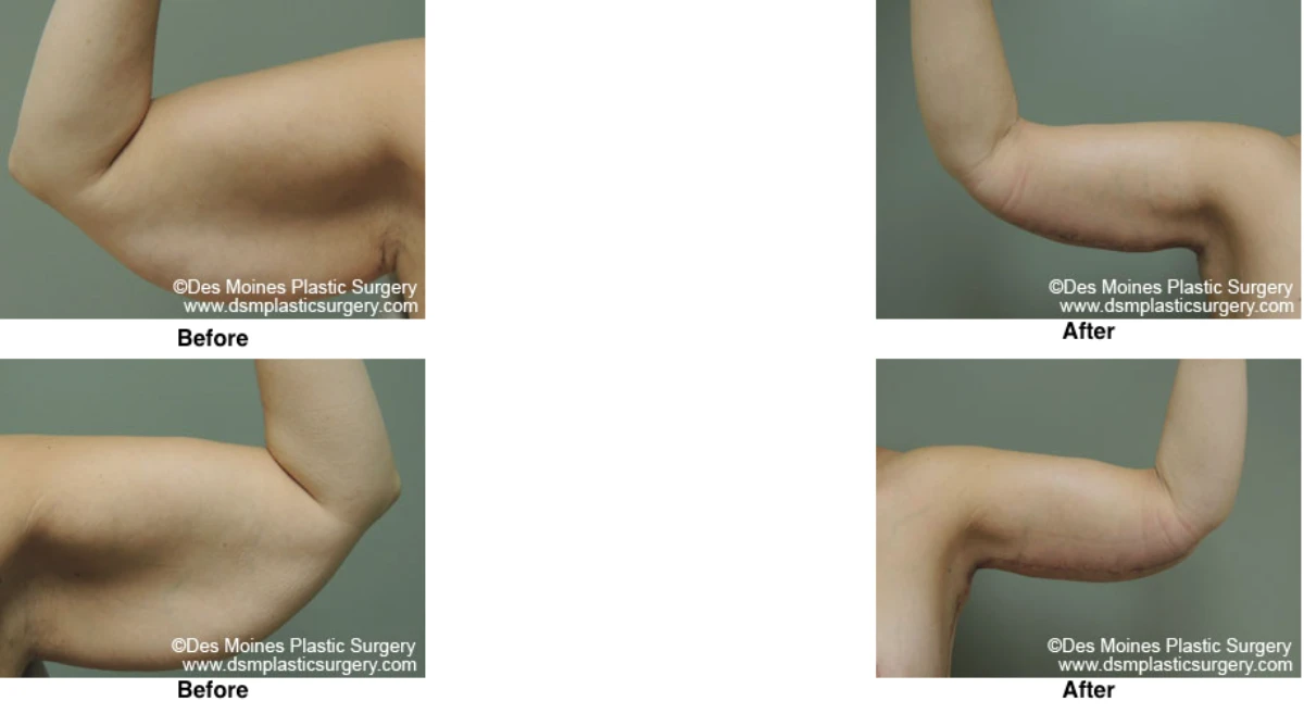 Arm Lift Before and After Performed by Dr David Robbins