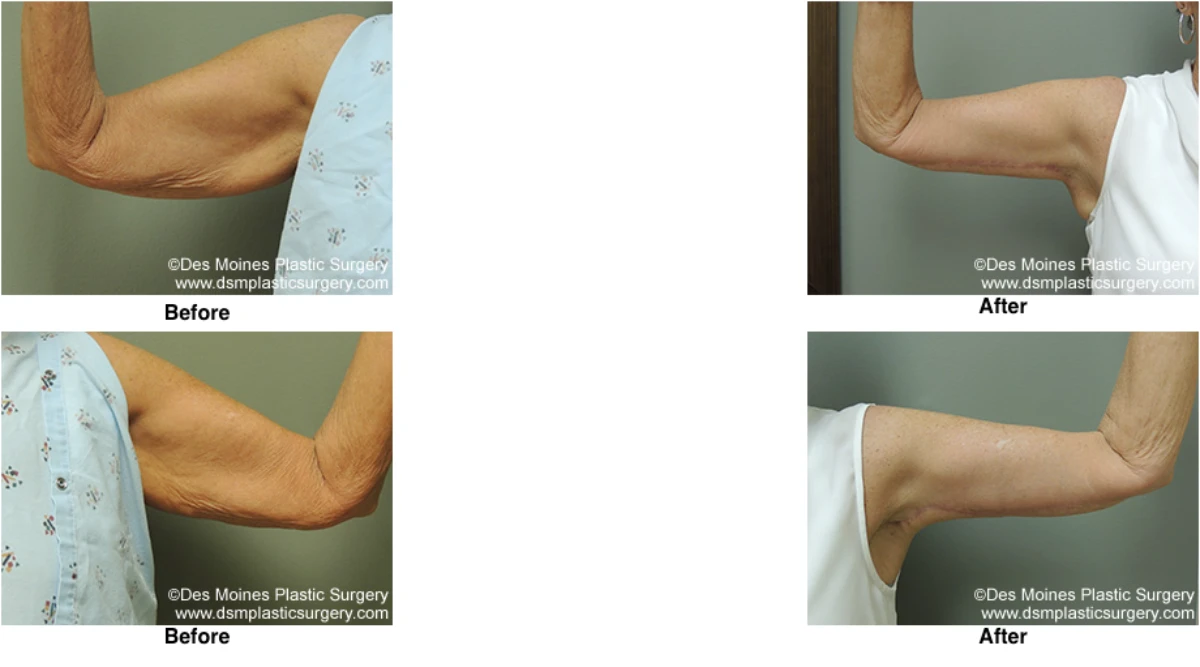 Arm Lift Before and After Performed by Dr David Robbins