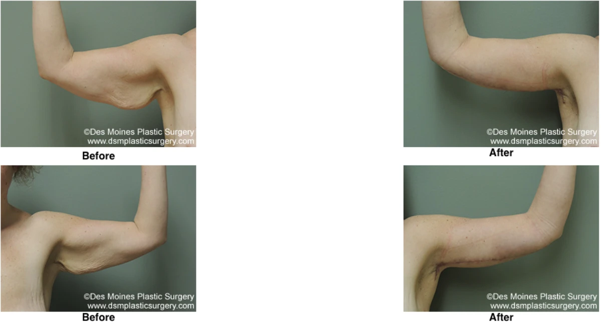 Arm Lift Before and After Performed by Dr David Robbins