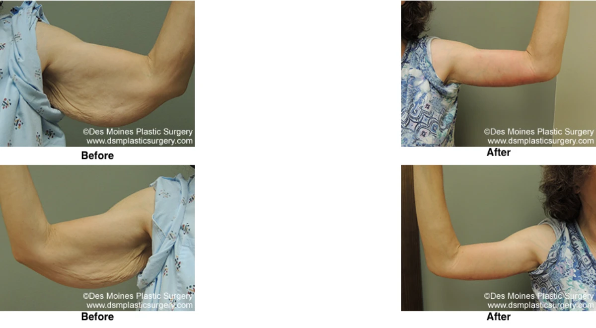 Arm Lift Before and After Performed by Dr David Robbins