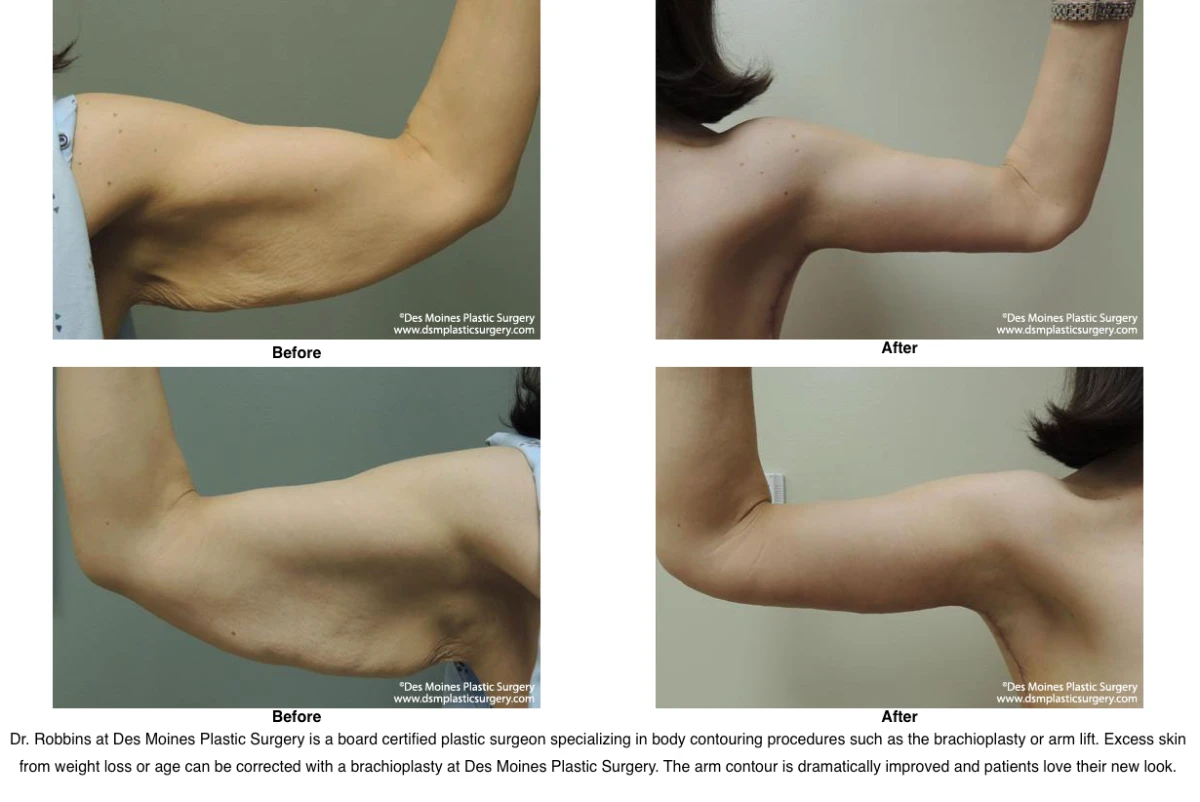 Arm Lift Before and After Performed by Dr David Robbins