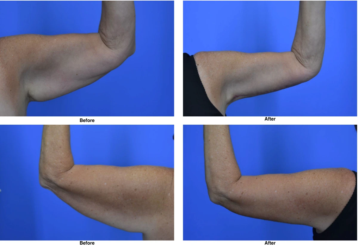 Arm Lift Before and After Performed by Dr David Robbins