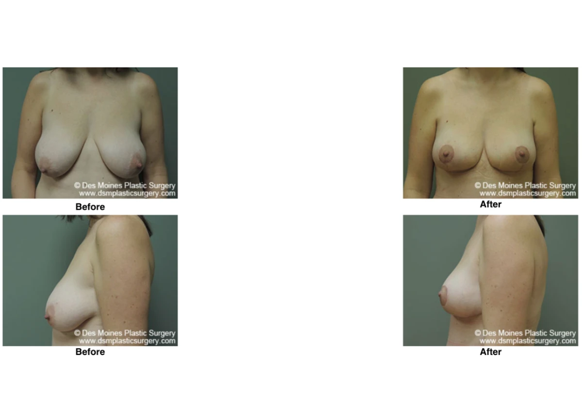 Breast Lift Before and After Performed by Dr David Robbins