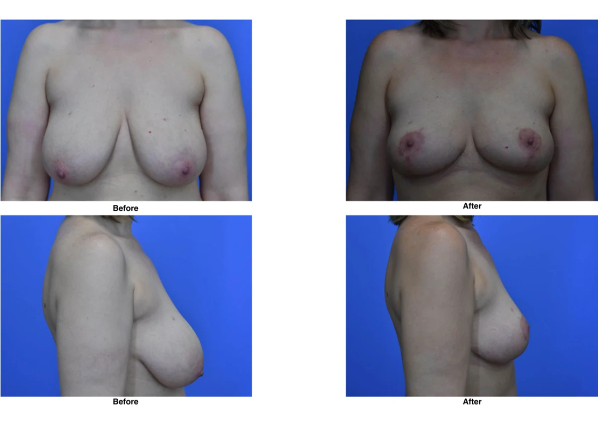 Breast Lift Before and After Performed by Dr David Robbins