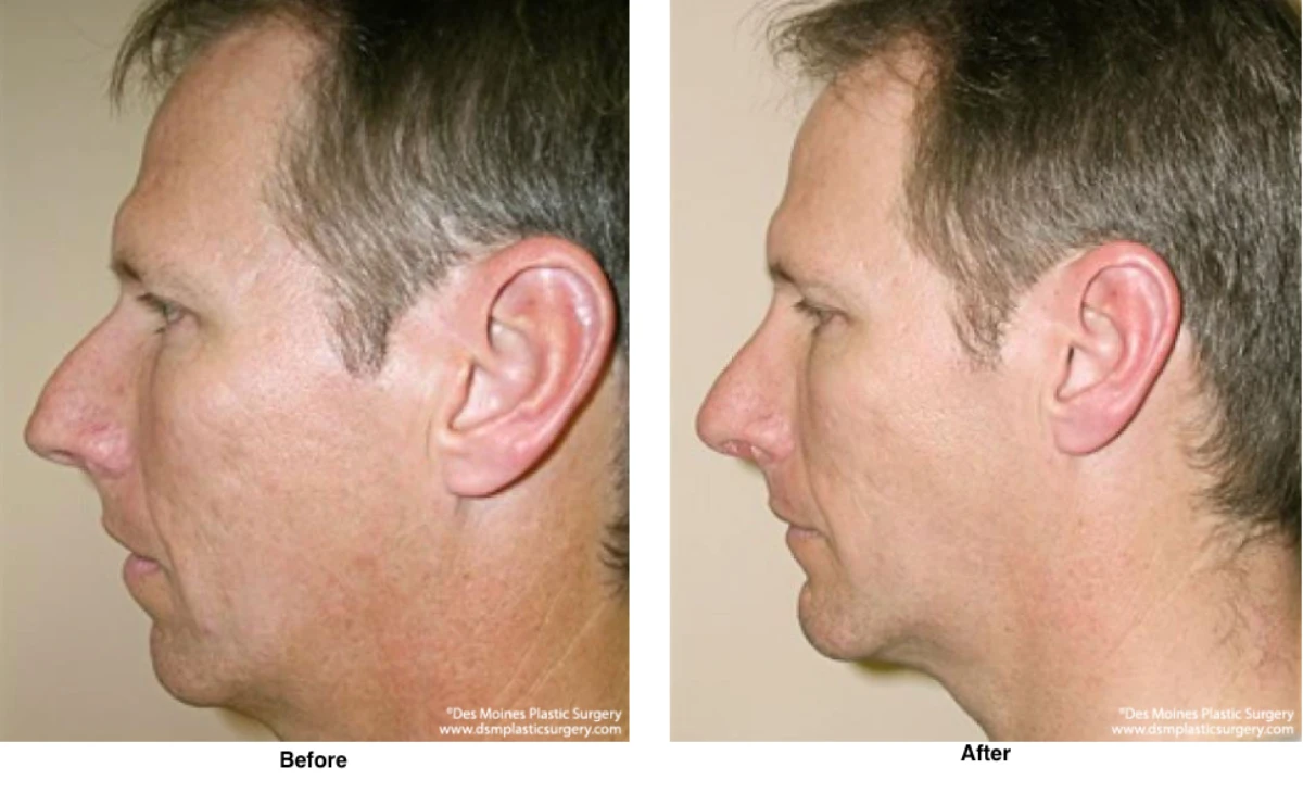 Chin Augmentation Before and After by Dr David Robbins