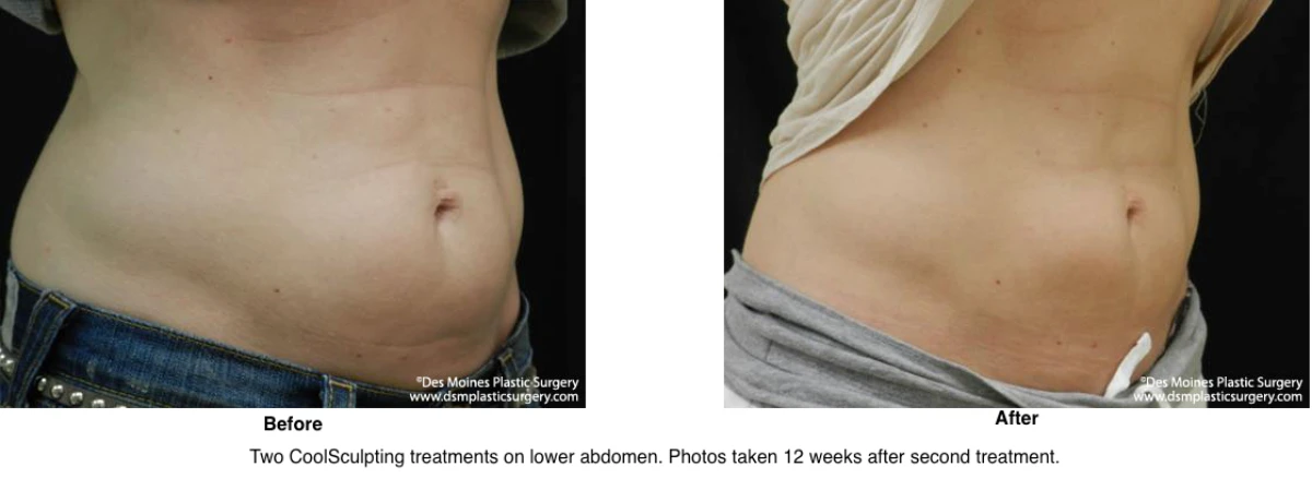 Coolsculpting Before and After Photo Performed by Dr David Robbins