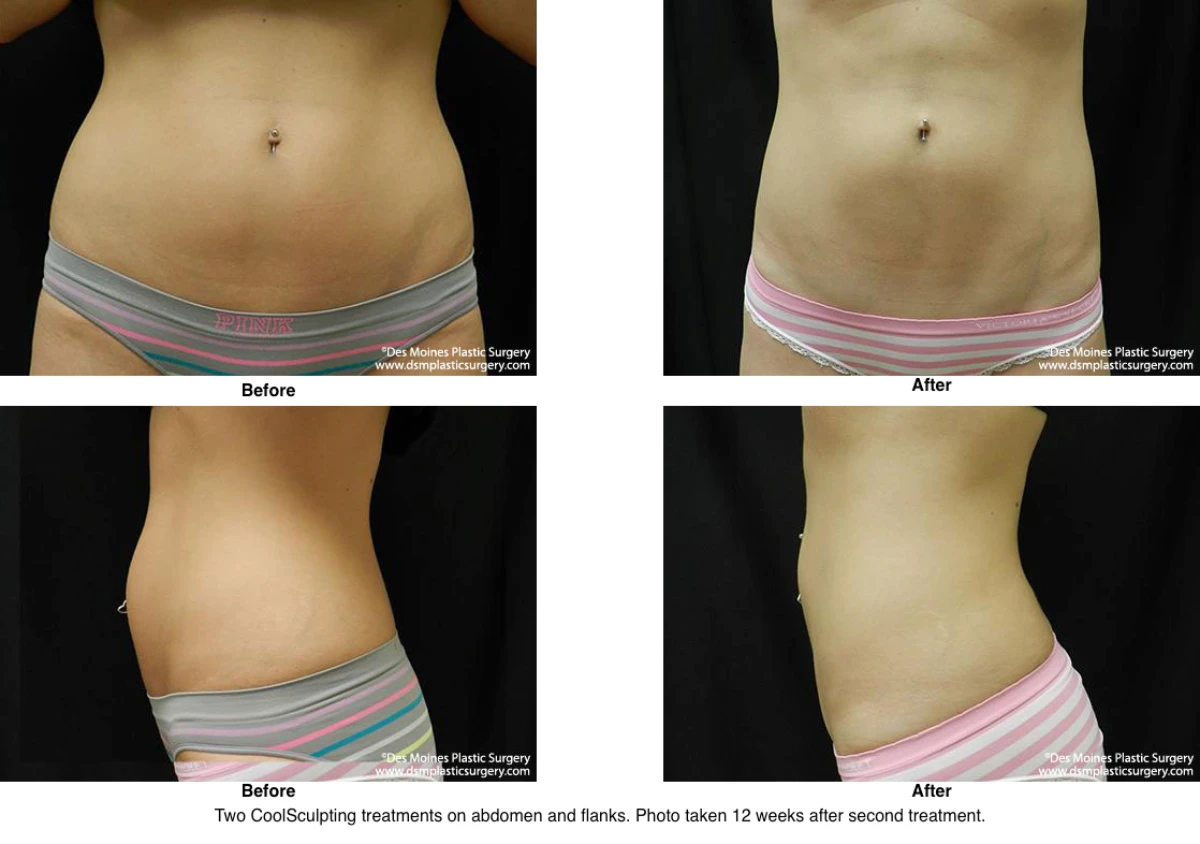 Coolsculpting Before and After Photo Performed by Dr David Robbins