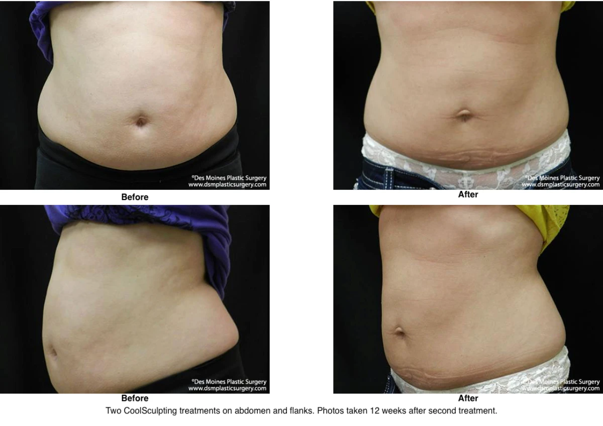 Coolsculpting Before and After Photo Performed by Dr David Robbins